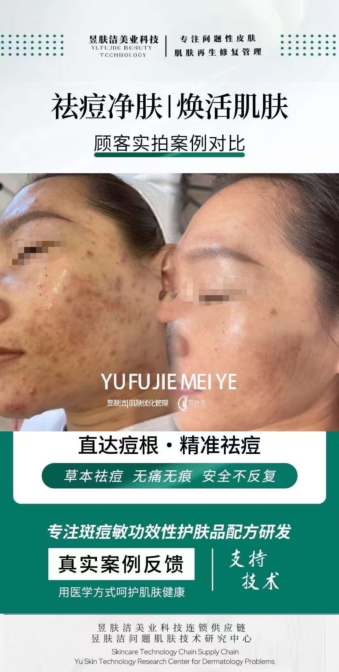 昱肤洁公司祛斑