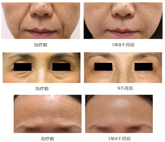 3D干细胞面部年轻化_2