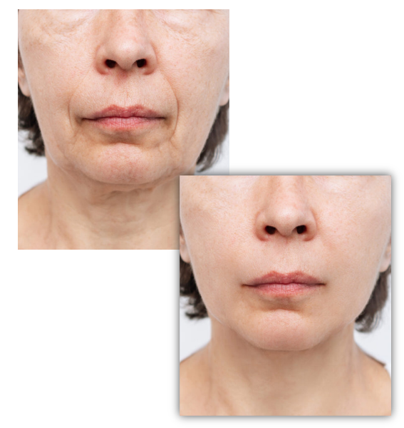 3D干细胞面部年轻化_1