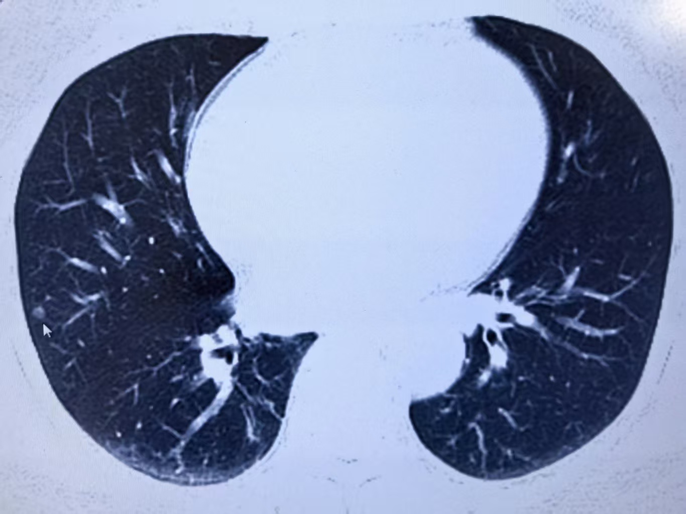 体检报告“肺结节”是肺结节病吗？