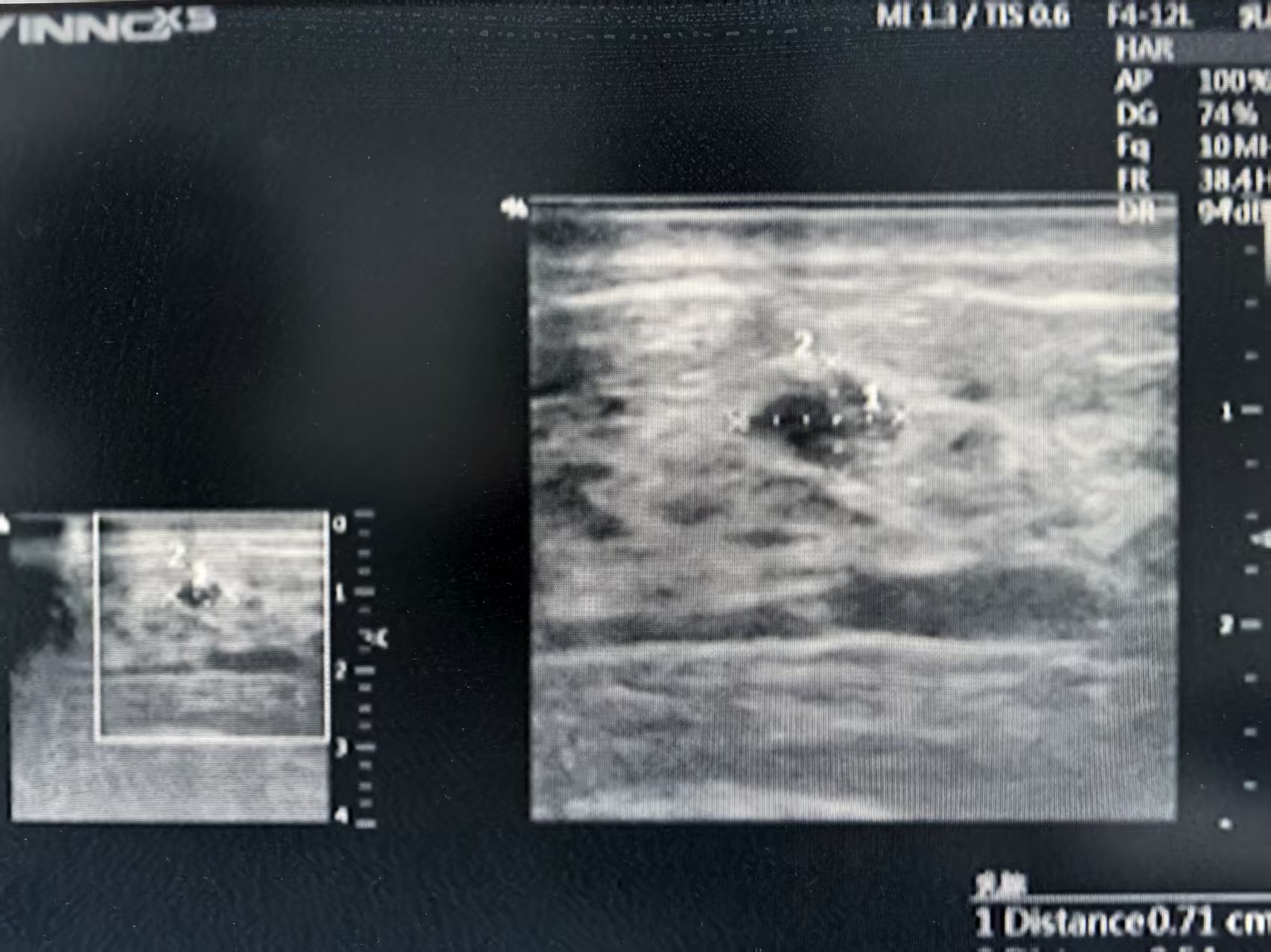 发现乳腺结节怎么办