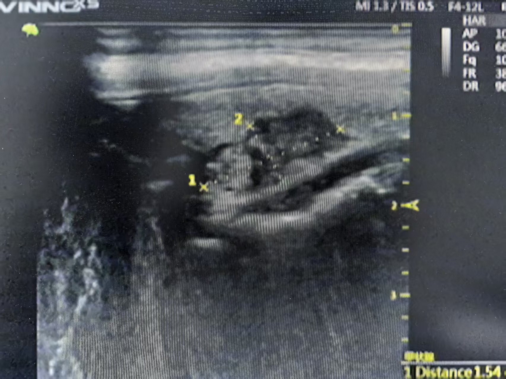 发现甲状腺结节怎么办？