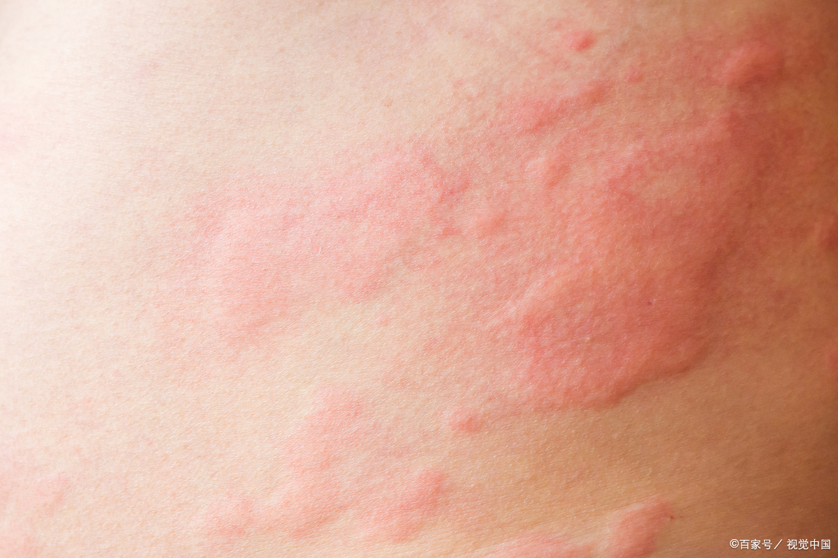 反复周身湿疹2年病案